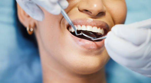 Best Emergency Dental Extractions in Vineyard, CA