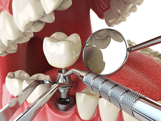 Best Emergency Root Canal Treatment in Vineyard, CA