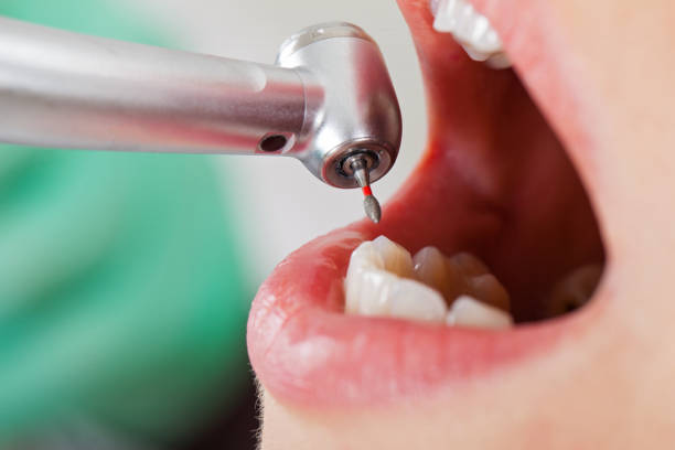 Best Emergency Dentist for Knocked-Out Tooth in Vineyard, CA